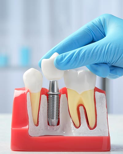 Dental Implants Near Me Serving Bay Area, San Jose, CA Dental Implants Near Me Serving Bay Area, San Jose, CA