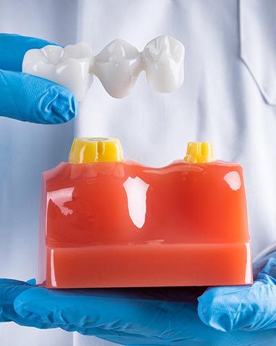 Dental Bridges Near Me Serving Bay Area, San Jose, CA Dental Bridges Near Me Serving Bay Area, San Jose, CA