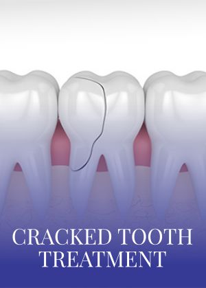 Cracked Tooth Treatment Serving in Bay Area, San Jose, CA Cracked Tooth Treatment Serving in Bay Area, San Jose, CA