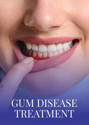Gum Disease Treatment Serving in Bay Area, San Jose, CA Gum Disease Treatment Serving in Bay Area, San Jose, CA